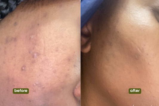 FREE Scar Butter (trial size)