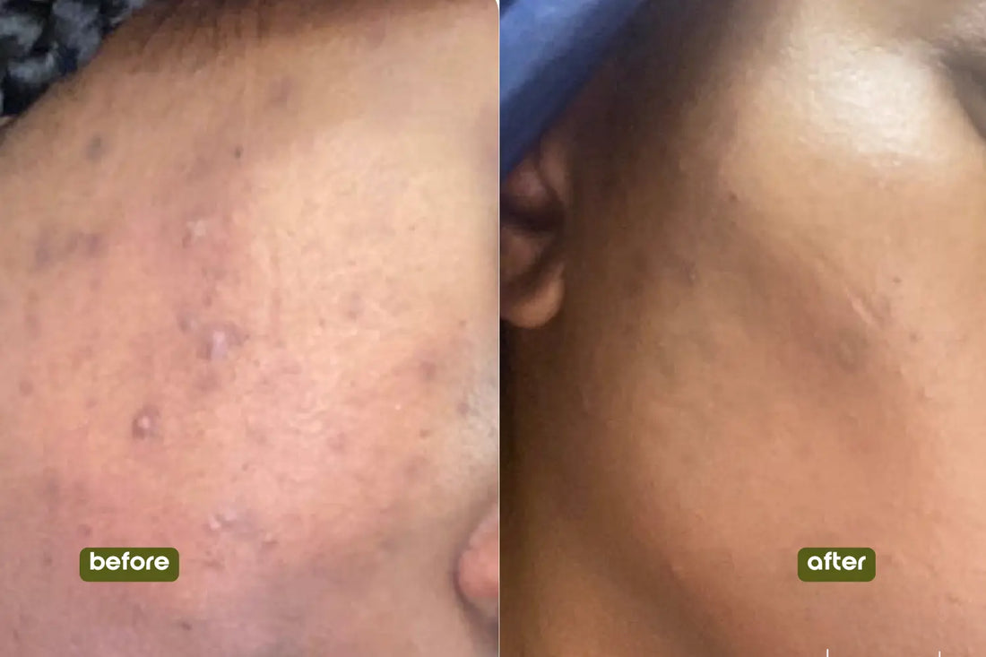 FREE Scar Butter (trial size) - Donata Skinfood