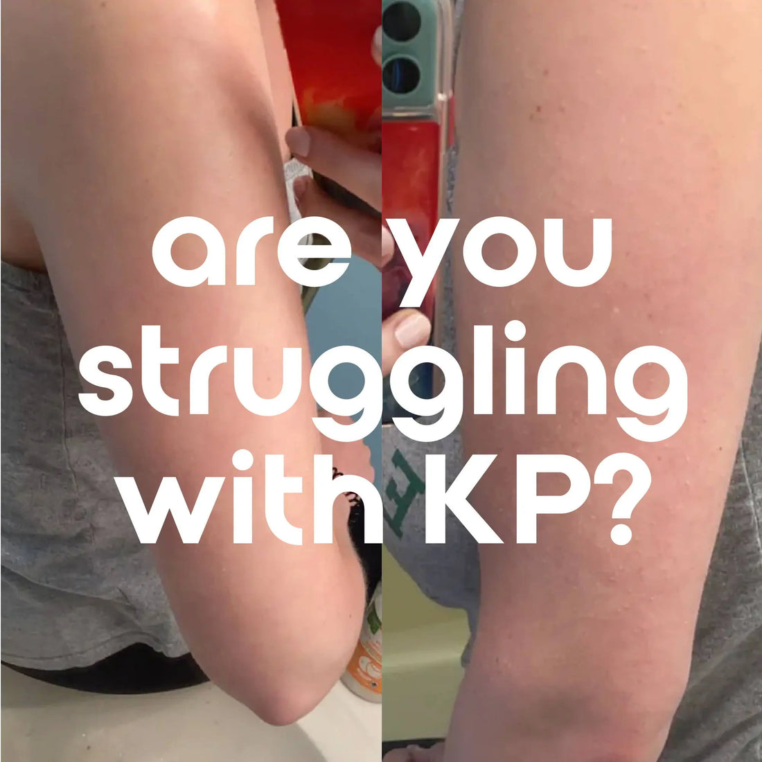 KP: What is it, and how do you treat it? - Donata Skinfood